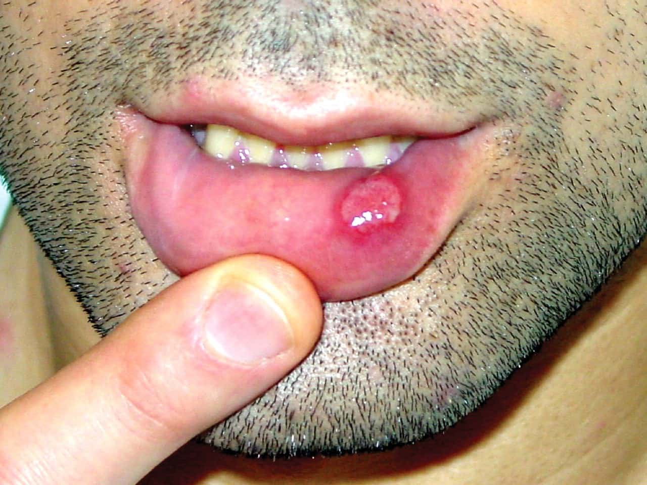 مرض متلازمة بهجت