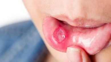 علاج قرحة الفم المزعجة